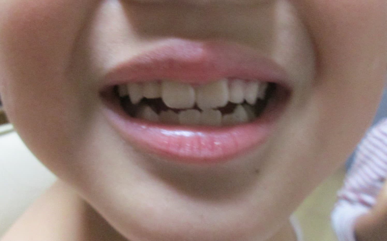 ７歳女の子歯列矯正前の写真